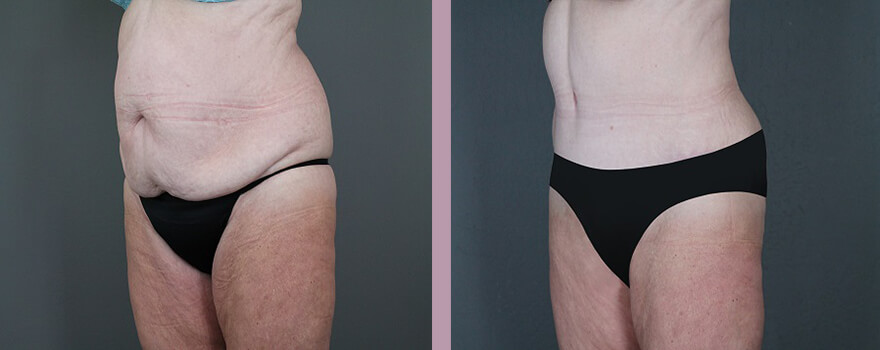 Case--5518 | Before and After Tummy Tuck 4