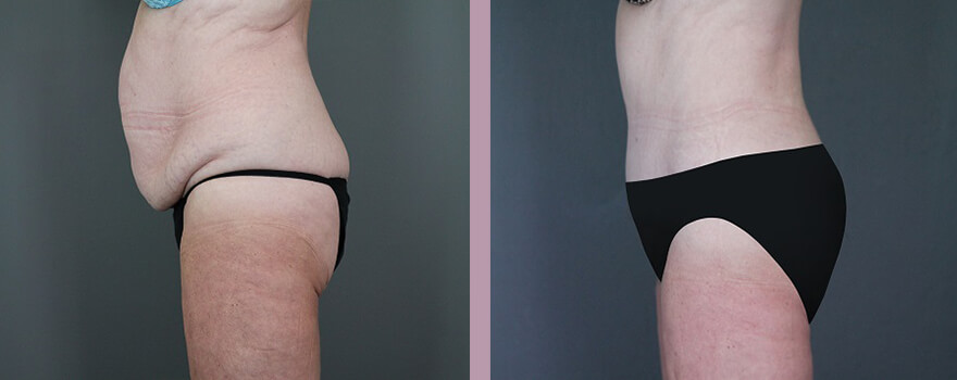 Case--5518 | Before and After Tummy Tuck 5