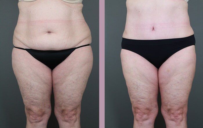 Case--6053 | Before and After Tummy Tuck