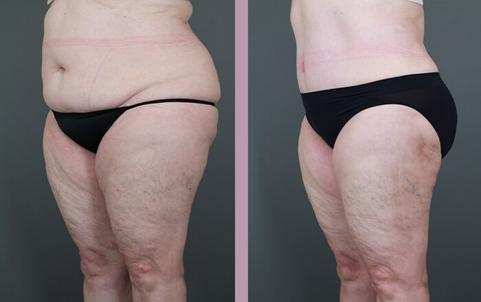 Case--6053 | Before and After Tummy Tuck 2
