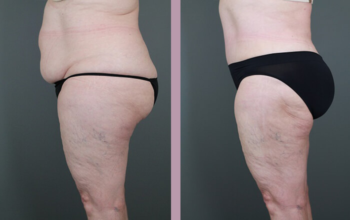 Case--6053 | Before and After Tummy Tuck 3