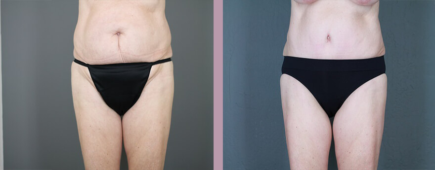Case--6129 | Before and After Tummy Tuck