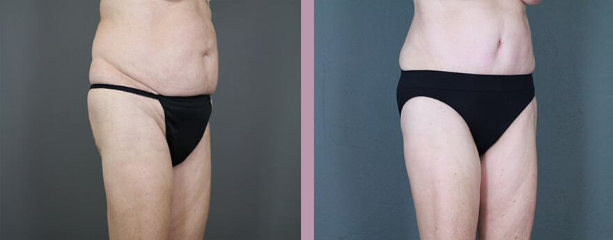 Case--6129 | Before and After Tummy Tuck 2