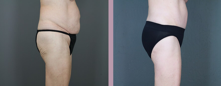 Case--6129 | Before and After Tummy Tuck 3