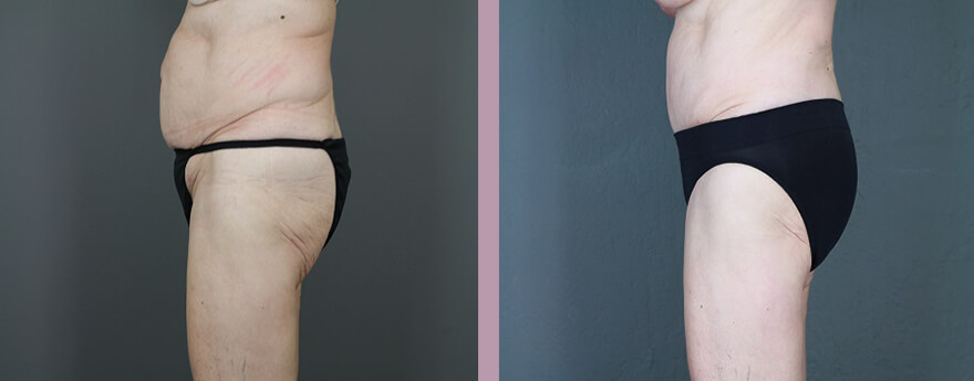 Case--6129 | Before and After Tummy Tuck 4