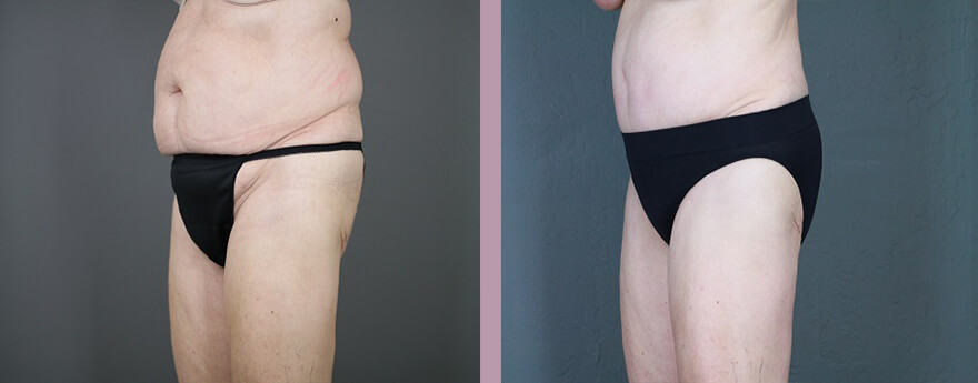 Case--6129 | Before and After Tummy Tuck 5