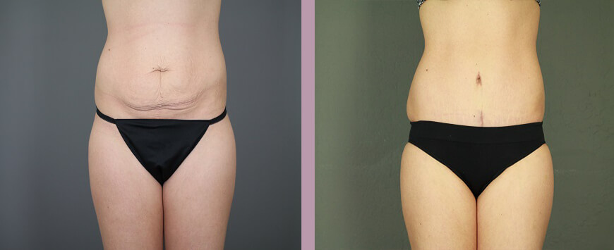 Case--6309 | Before and After Tummy Tuck