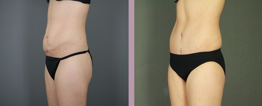 Case--6309 | Before and After Tummy Tuck 2