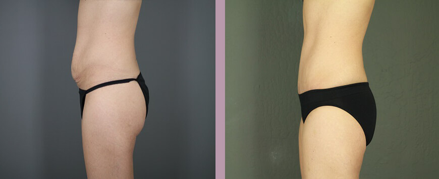 Case--6309 | Before and After Tummy Tuck 3