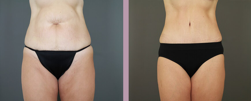 Case--6422 | Before and After Tummy Tuck