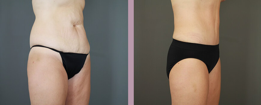 Case--6422 | Before and After Tummy Tuck 2