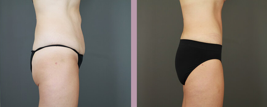 Case--6422 | Before and After Tummy Tuck 3