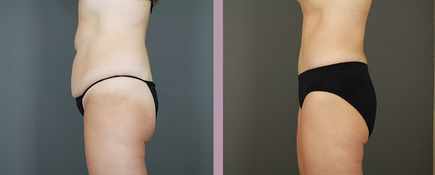 Case--6422 | Before and After Tummy Tuck 4