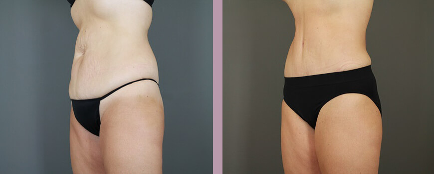 Case--6422 | Before and After Tummy Tuck 5