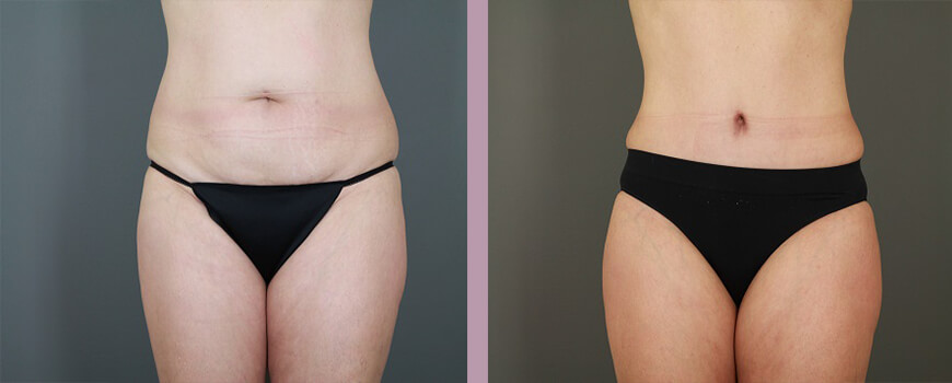 Case--6475 | Before and After Tummy Tuck