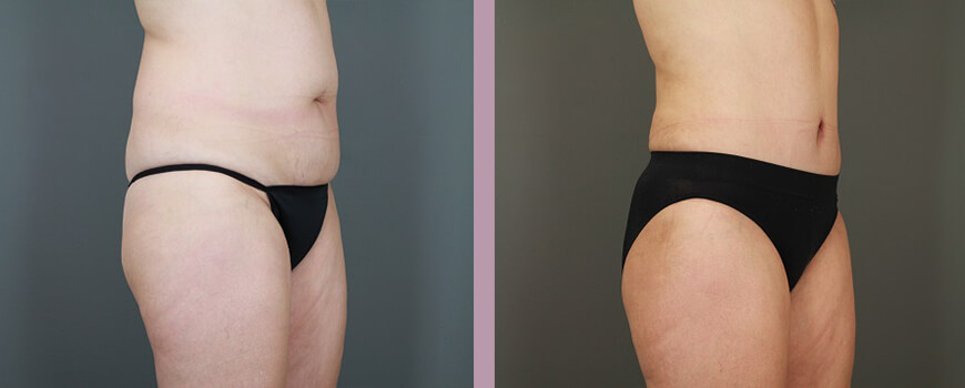 Case--6475 | Before and After Tummy Tuck 2