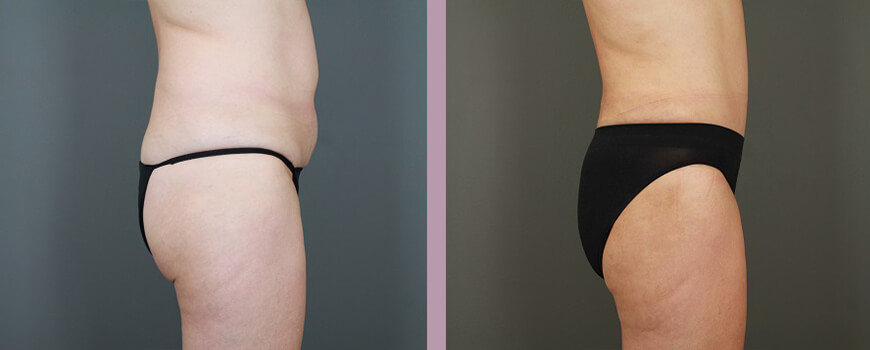 Case--6475 | Before and After Tummy Tuck 3
