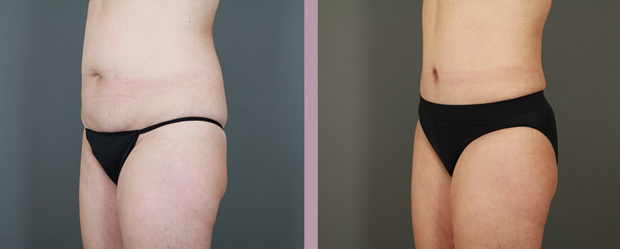 Case--6475 | Before and After Tummy Tuck 4