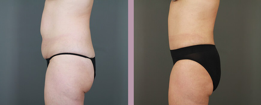 Case--6475 | Before and After Tummy Tuck 5