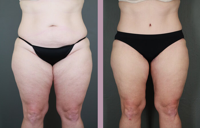 Case--6522 | Before and After Tummy Tuck 1