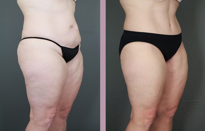 Case--6522 | Before and After Tummy Tuck 2