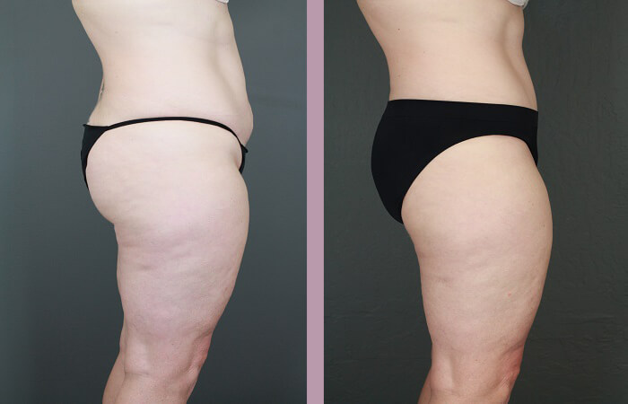 Case--6522 | Before and After Tummy Tuck 3