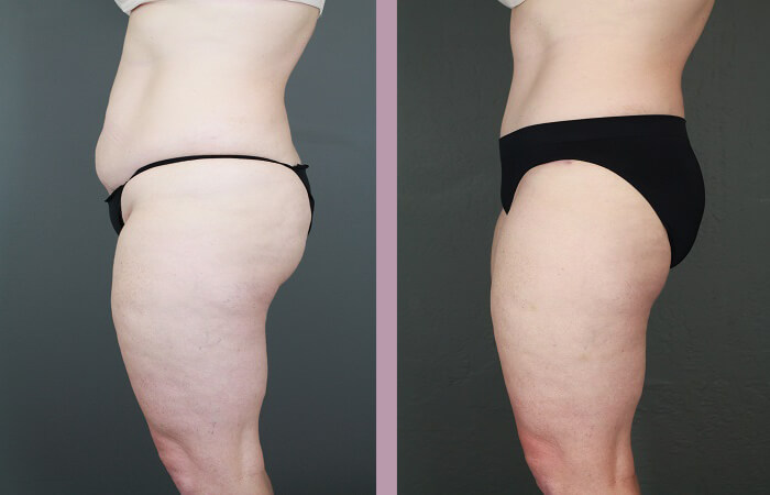 Case--6522 | Before and After Tummy Tuck 4