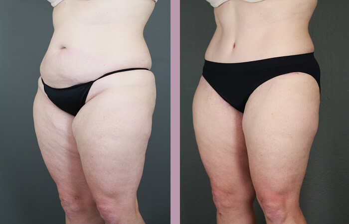 Case--6522 | Before and After Tummy Tuck 5
