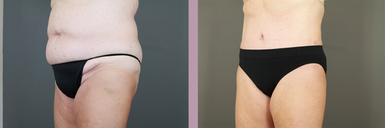 Case--6536 | Before and After Tummy Tuck 2