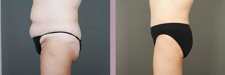 Case--6536 | Before and After Tummy Tuck 3