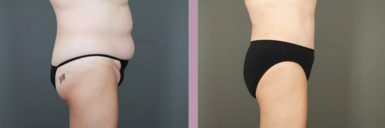 Case--6536 | Before and After Tummy Tuck 4