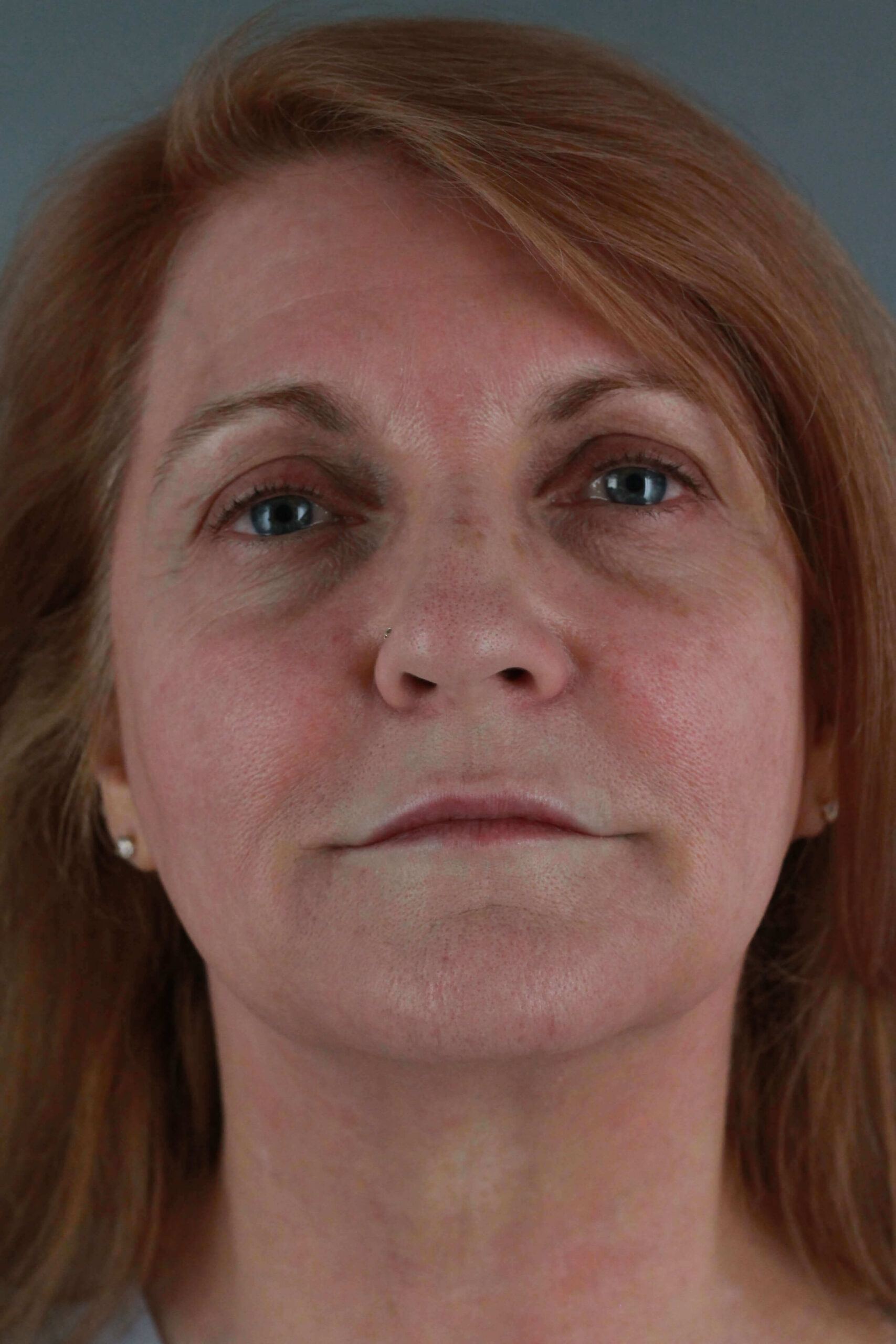 Case--6550 | After Voluma