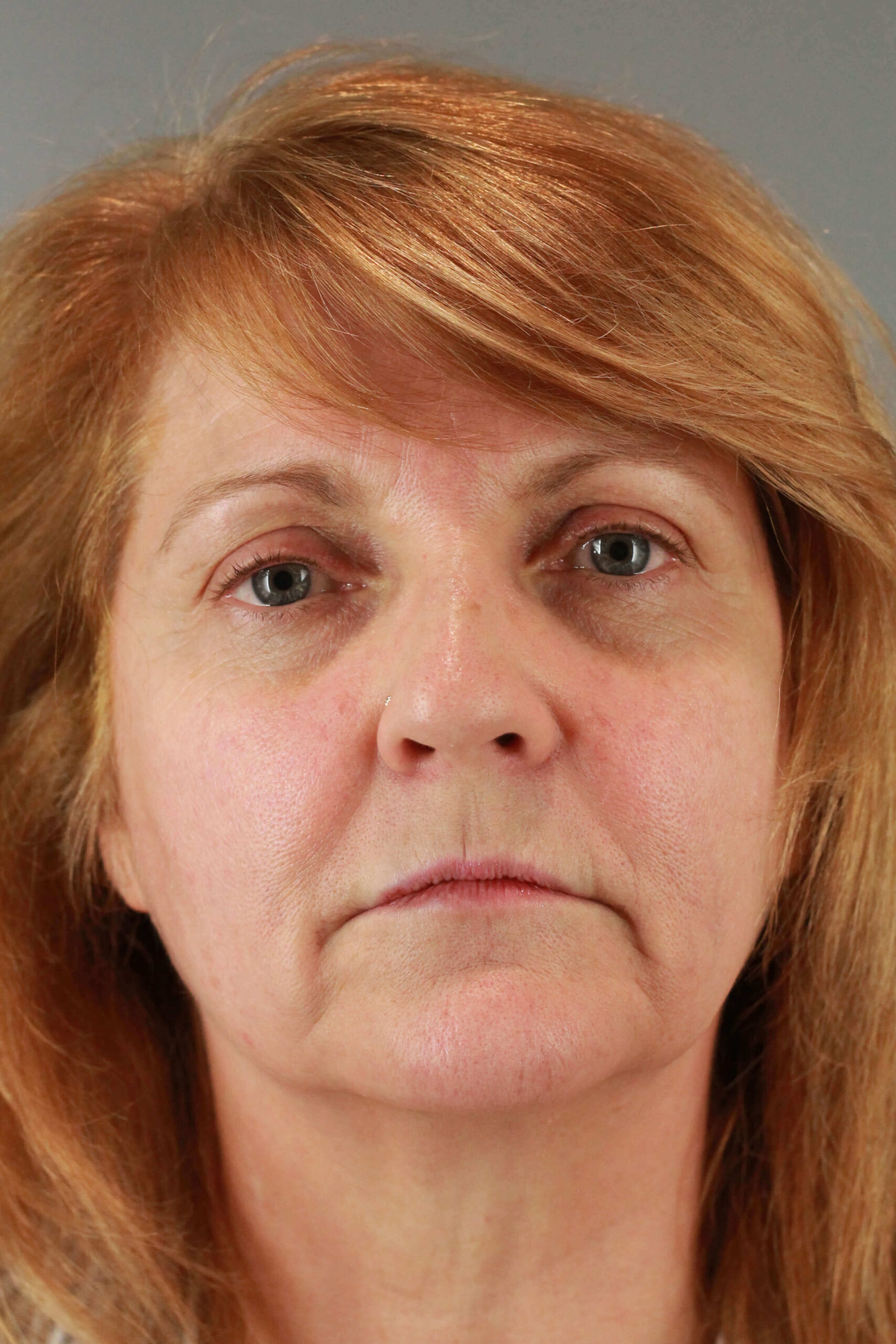 Case--6550 | Before Voluma