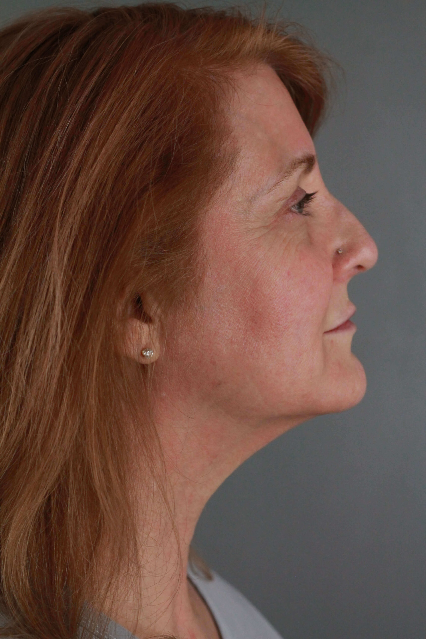 Case--6550 | After Voluma 3