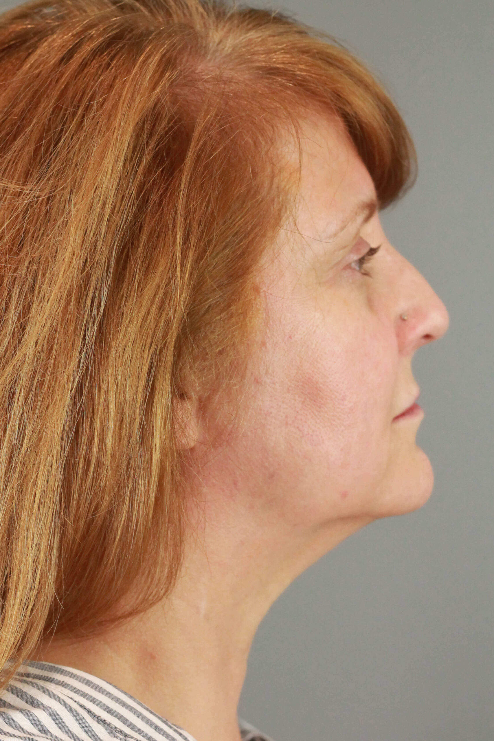 Case--6550 | Before Voluma 3