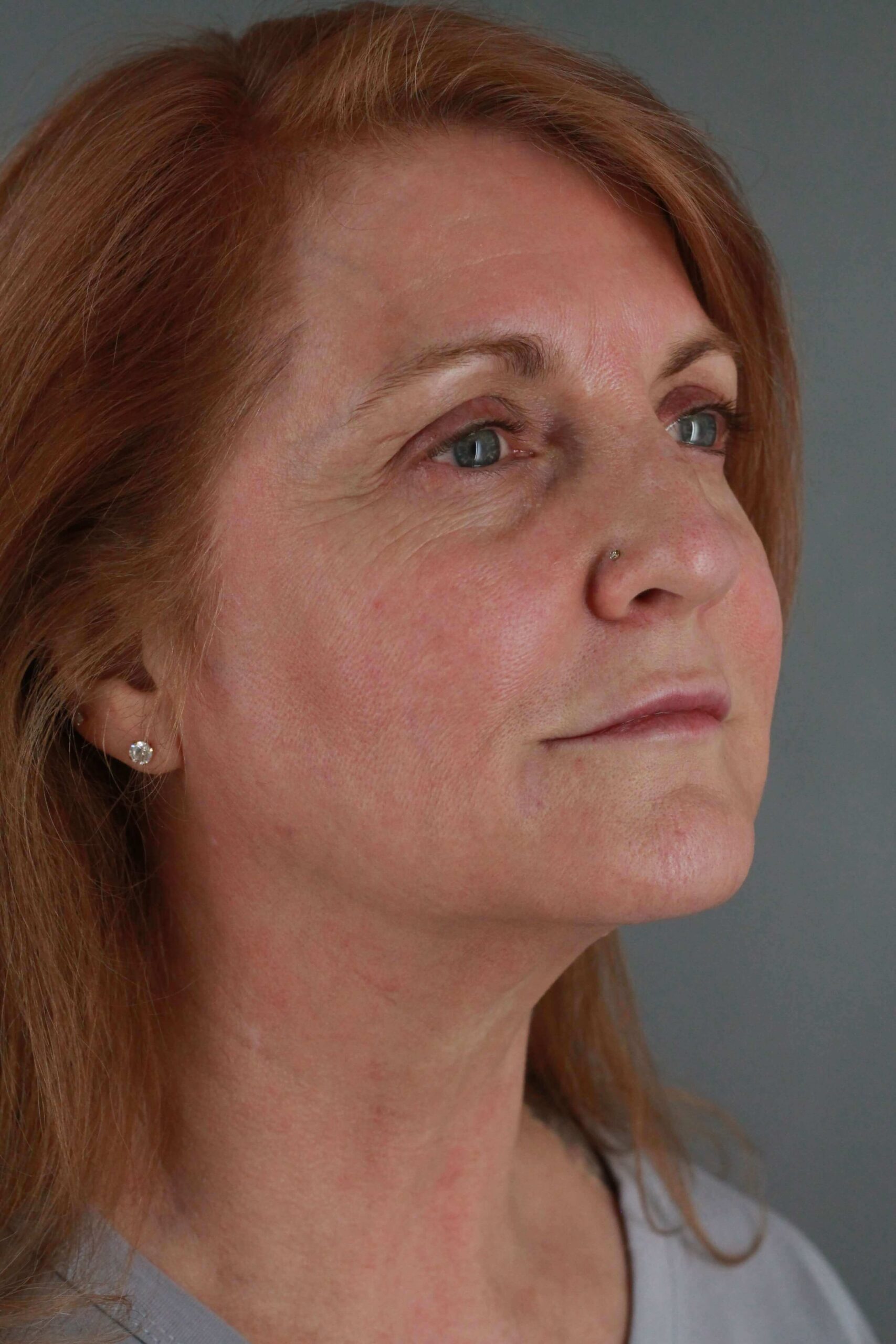 Case--6550 | After Voluma 2