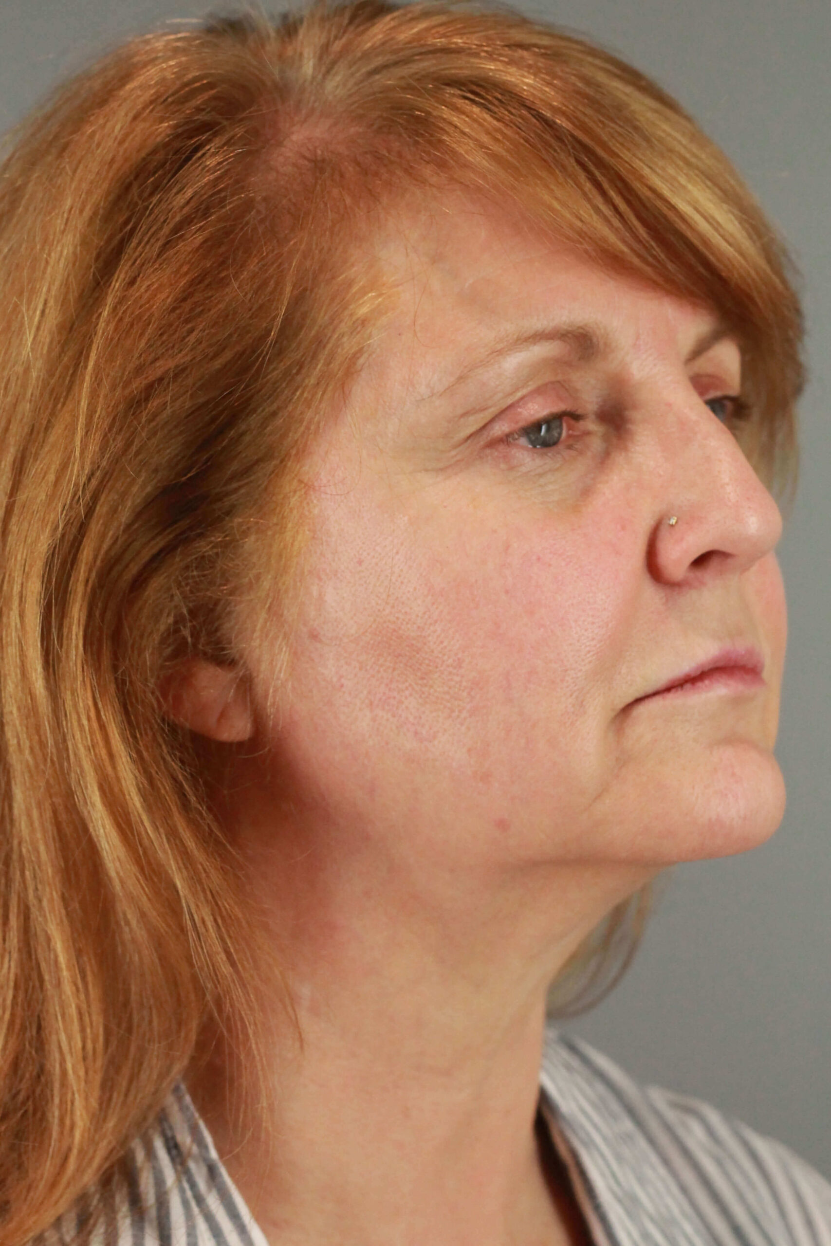 Case--6550 | Before Voluma 2