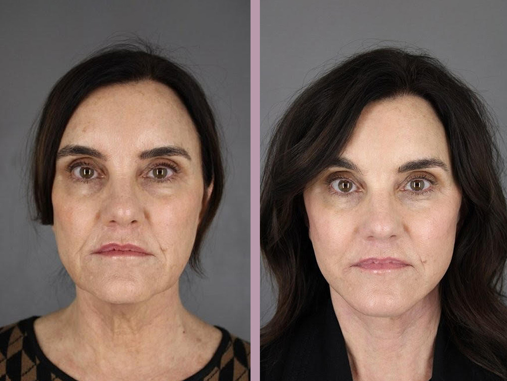 Case--33327 | Before and After Facelift