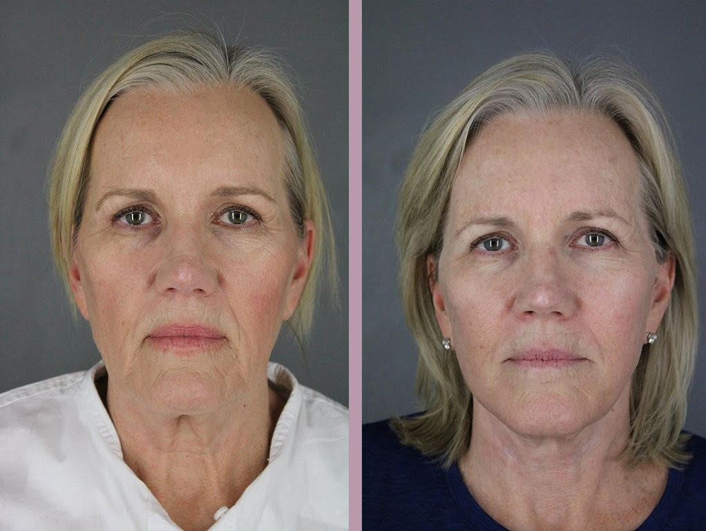 Case--33352 | Before and After Facelift