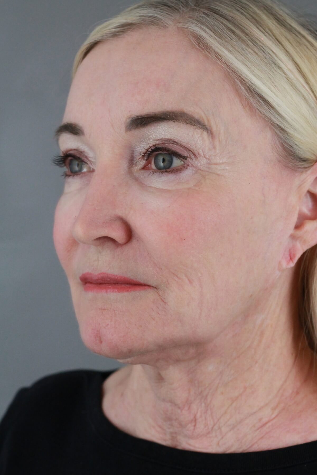 Case--2012 | After Volbella 2