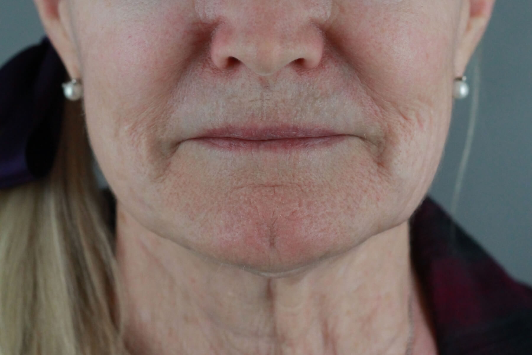 Case--2012 | Before Volbella 4