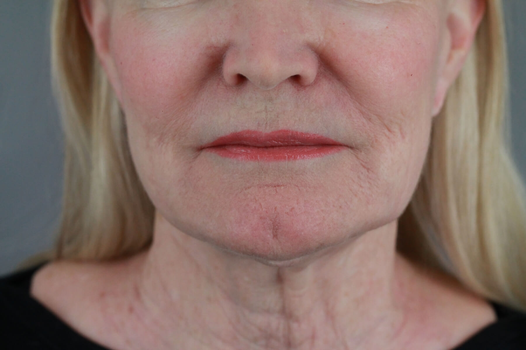 Case--2012 | After Volbella 4