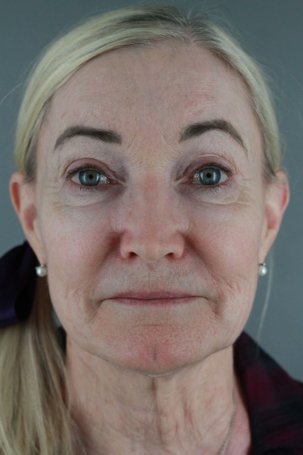 Case--2012 | Before Volbella