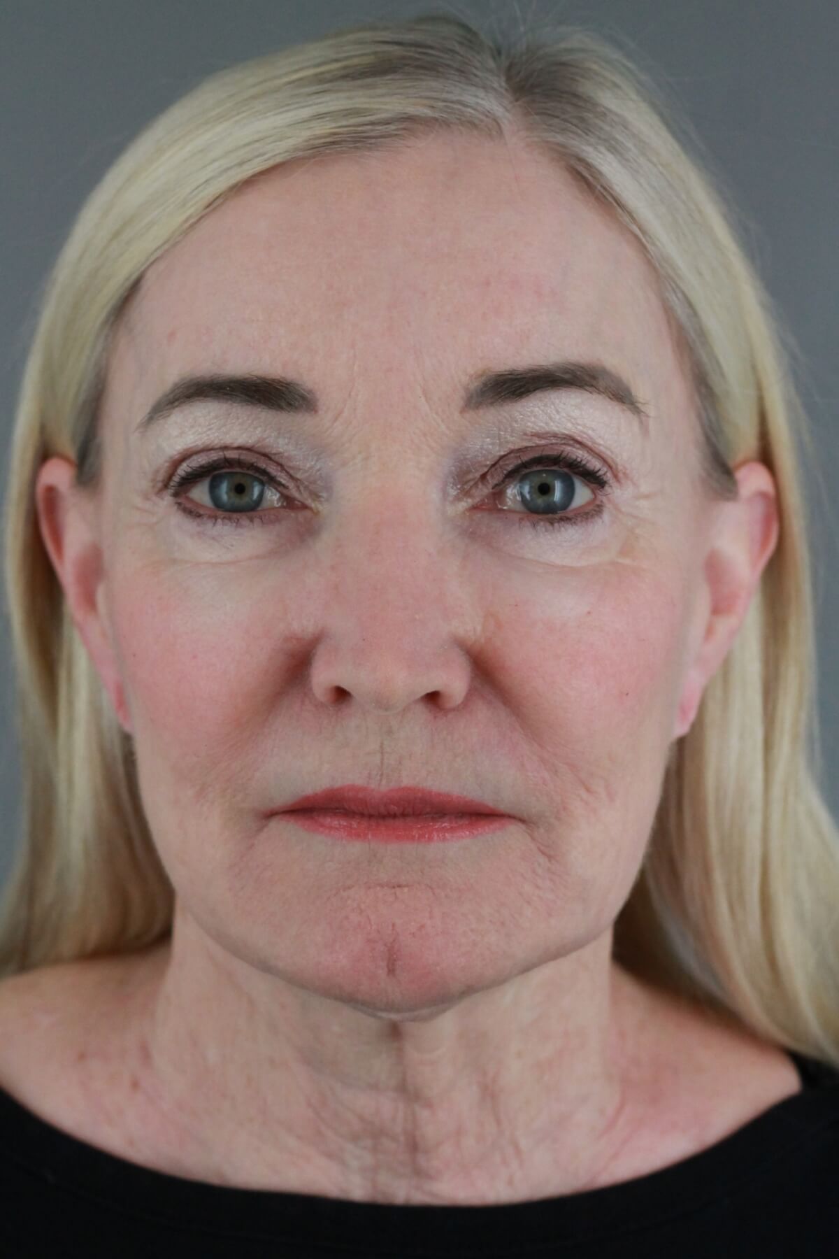 Case--2012 | After Volbella