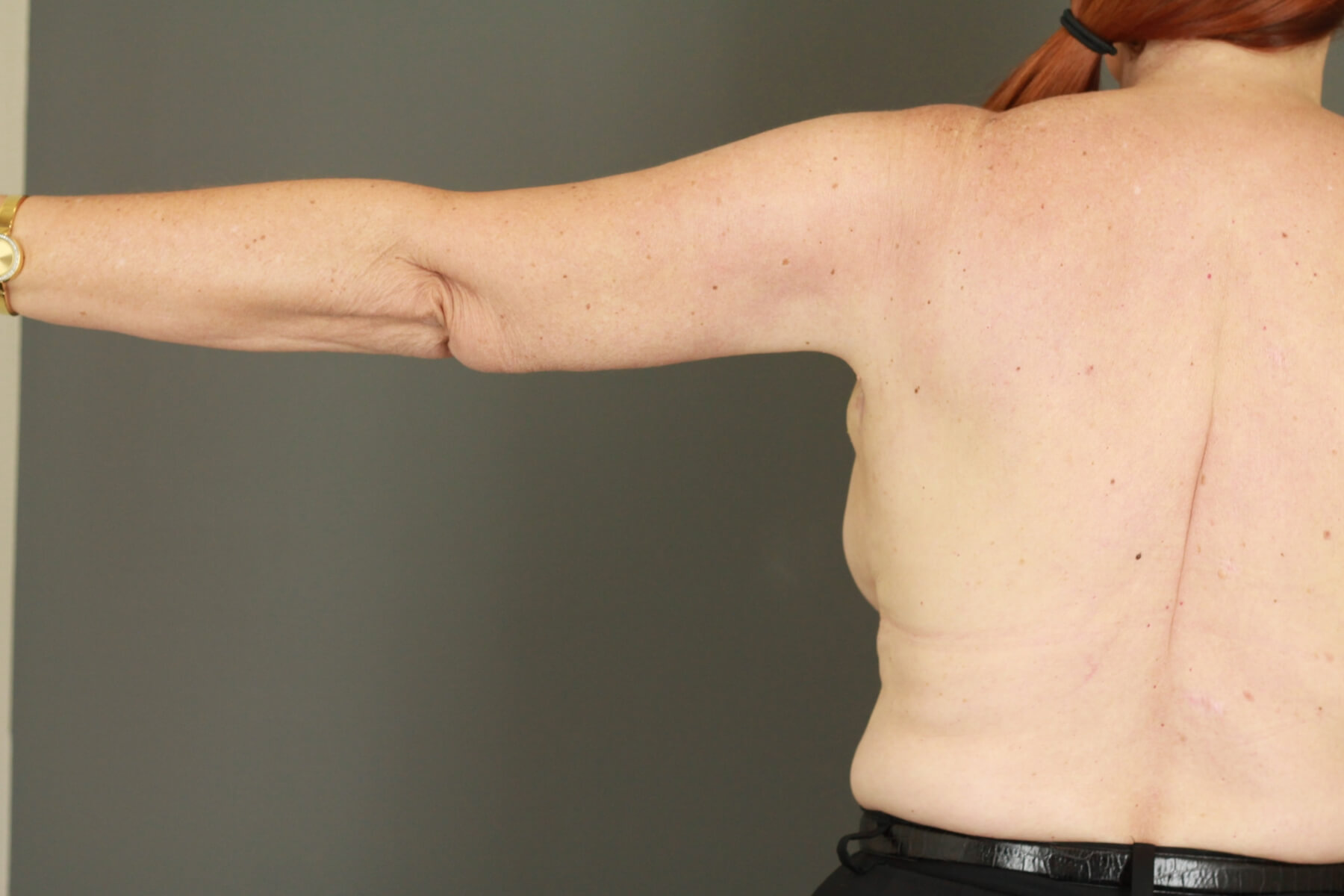 Case--6030 | After Arm Lift 2