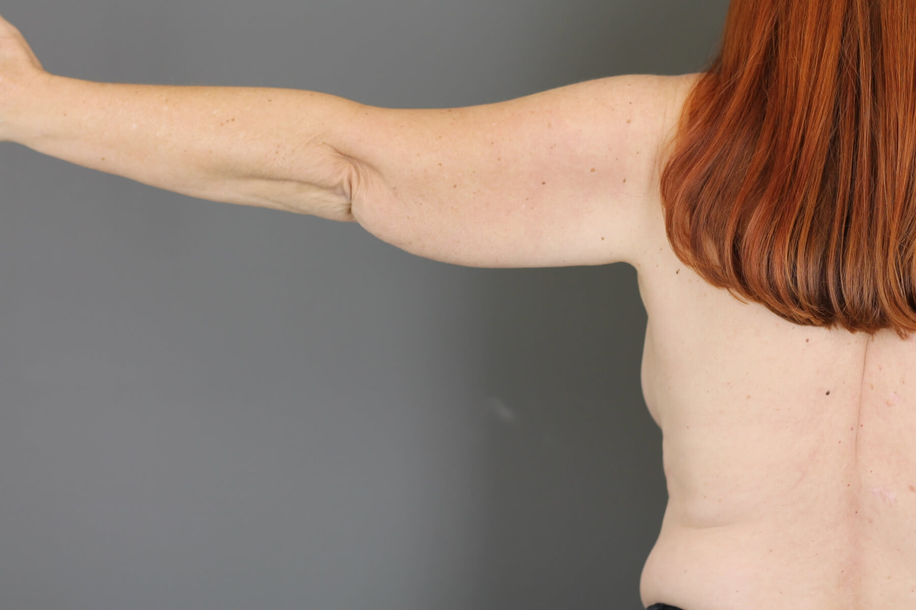 Case--6030 | Before Arm Lift 2