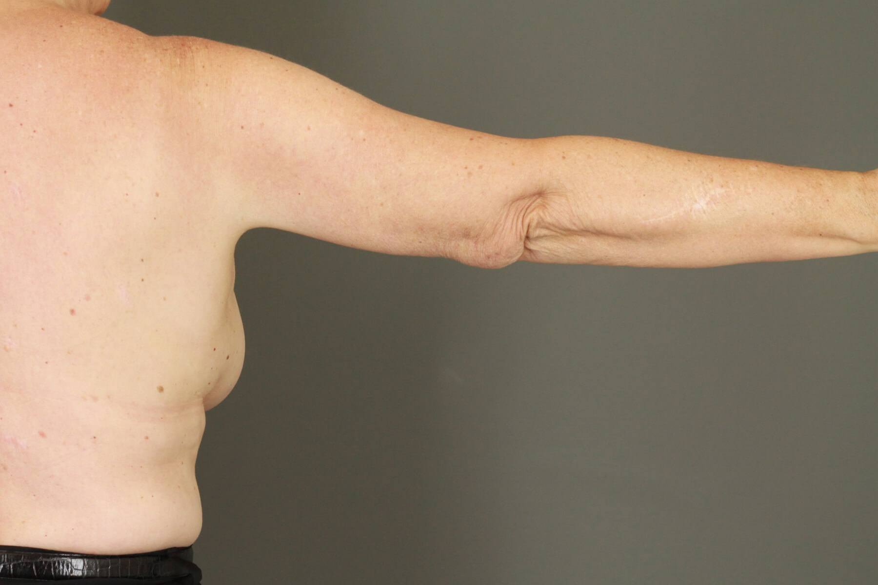 Case--6030 | After Arm Lift 3