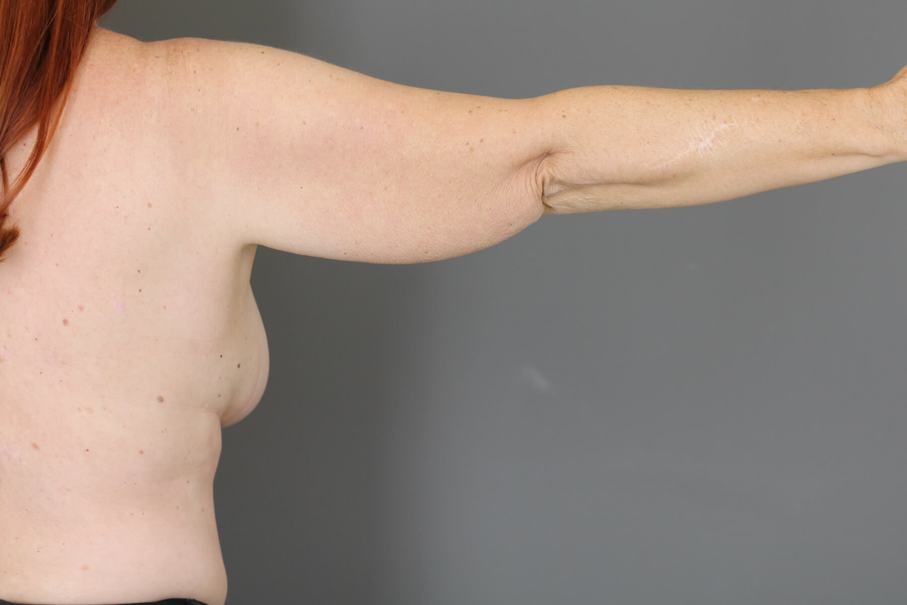 Case--6030 | Before Arm Lift 3