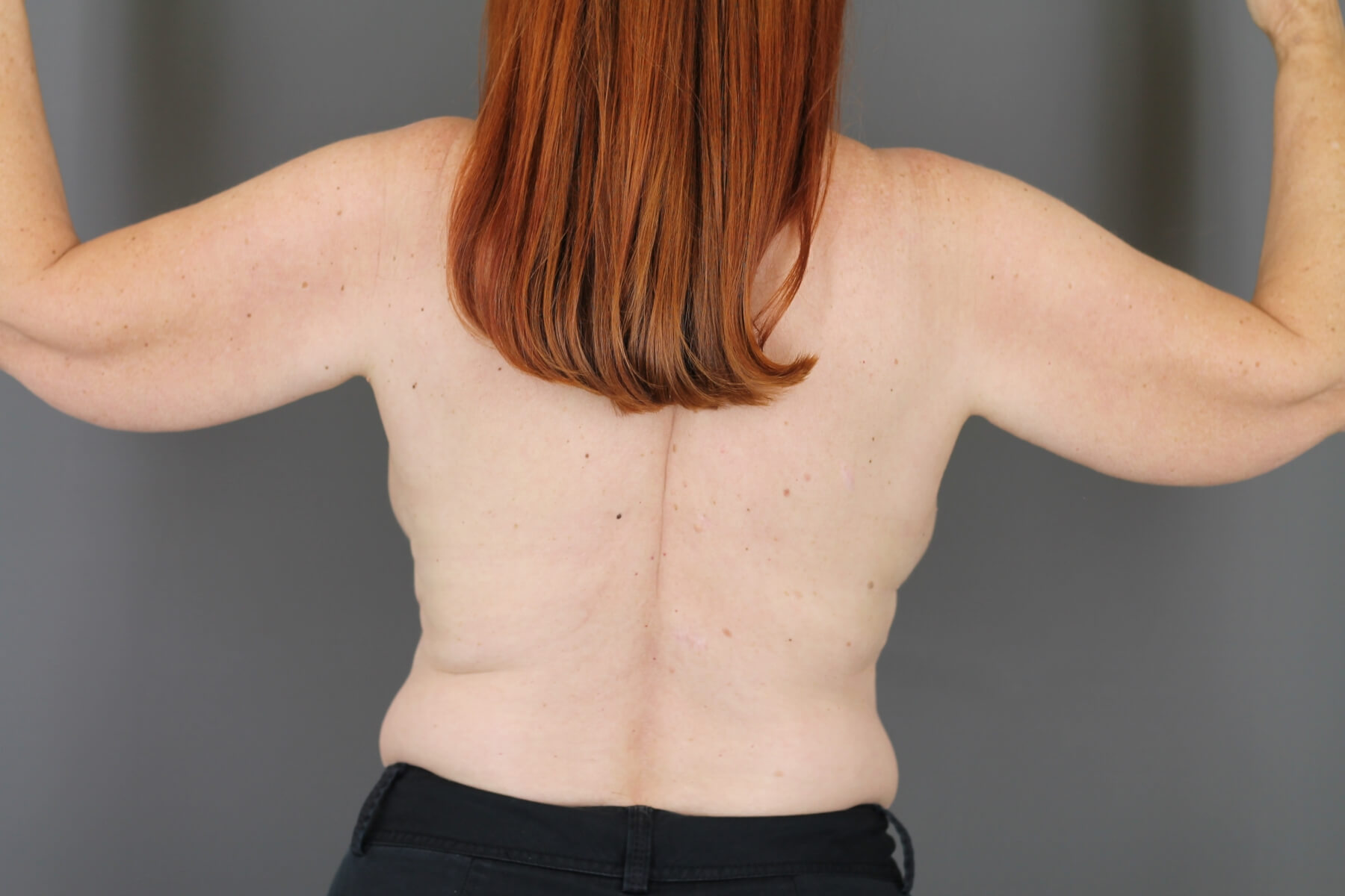 Case--6030 | Before Arm Lift