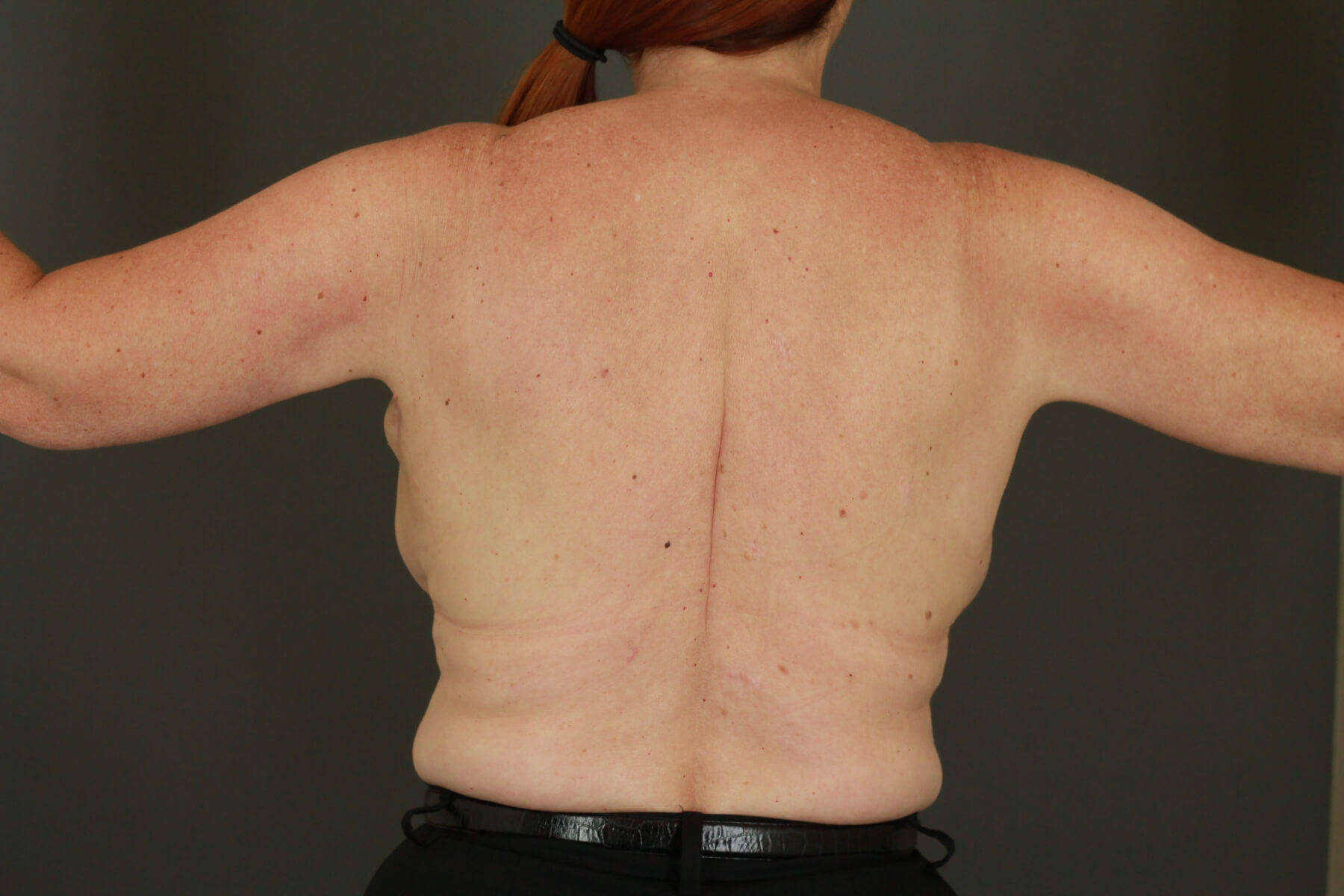 Case--6030 | After Arm Lift